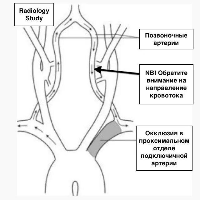 Сужение правой артерии. Брахиоцефальные артерии схема. Брахиоцефальных артерий артерии шеи. Сегменты позвоночной артерии схема УЗИ. Устье позвоночной артерии кт.