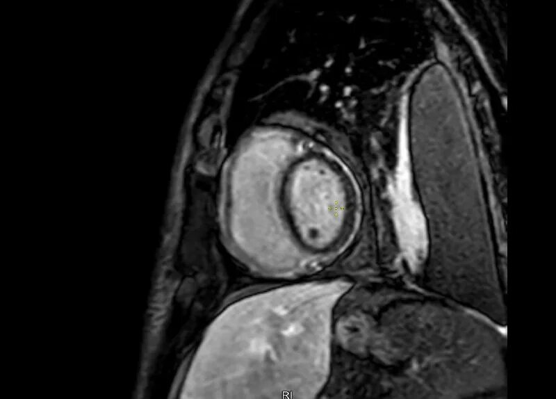 Мрт контрастное вещество мозг. Мрт накапливается контраст. Мрт накапливается контраст. Мрт контрастирование. Накопление контраста при кт головы.