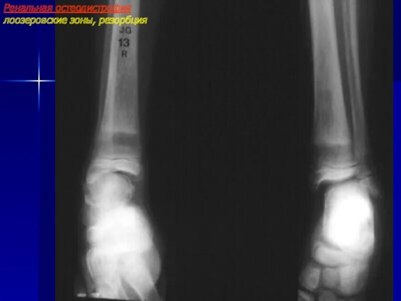 Зона перестройки. Лоозеровские зоны перестройки рентген. Рентген лоозеровская зона. Лоозеровская зона перестройки большеберцовой кости. Зона просветления Лоозера.