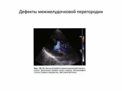 Высокий дефект