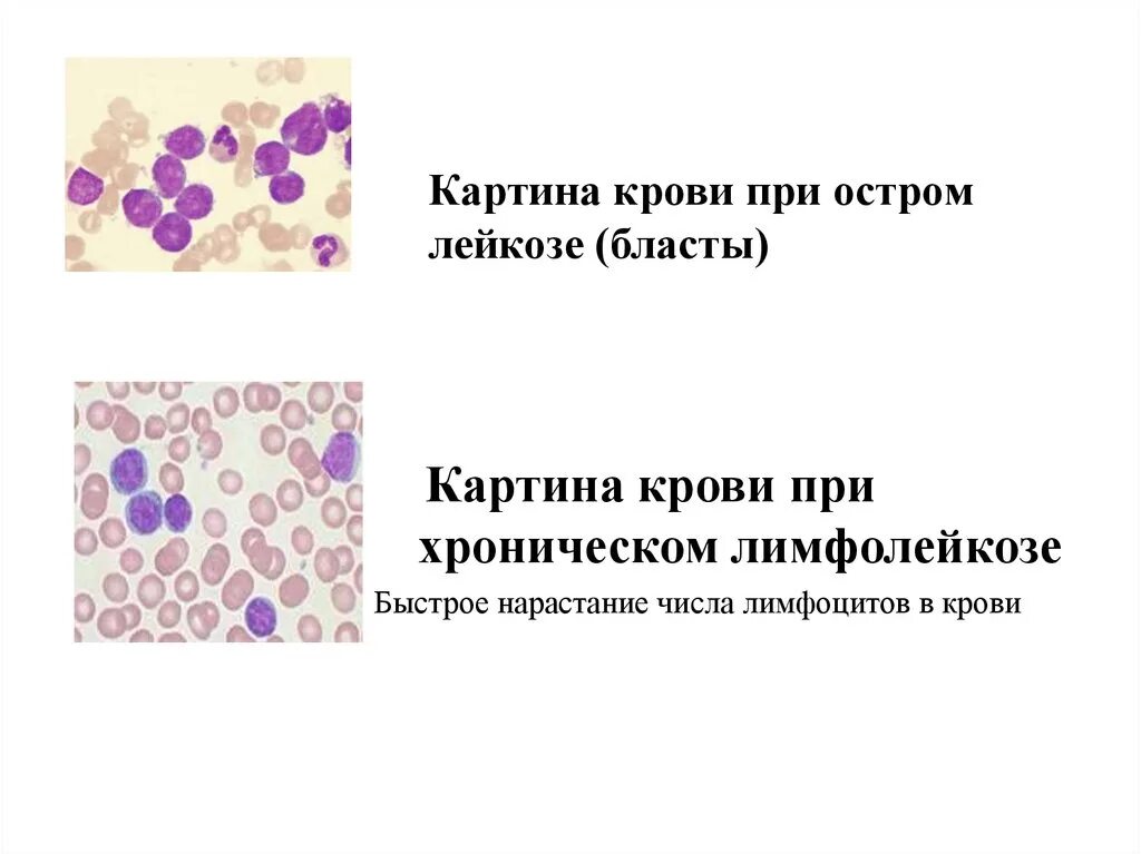 Картина крови при хроническом миелоидном лейкозе. Картина крови при хроническом лимфобластном лейкозе. Острый лейкоз картина крови. Острый лимфобластный лейкоз мазок. Кровь при лимфолейкозе