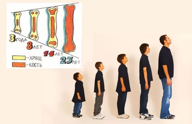 Кальцийпенический рахит. Костная ткань остеопороз. Остеопороз позвоночника 4 степени. Рахит искривление костей. Изменения костей у детей.