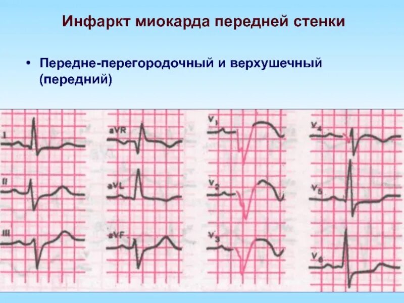 Изменение миокарда передне перегородочной области. Инфаркт миокарда передней стенки ЭКГ. Острый передний инфаркт миокарда на ЭКГ. Передневерхушечный инфаркт на ЭКГ. Передне-перегородочный инфаркт миокарда на ЭКГ.