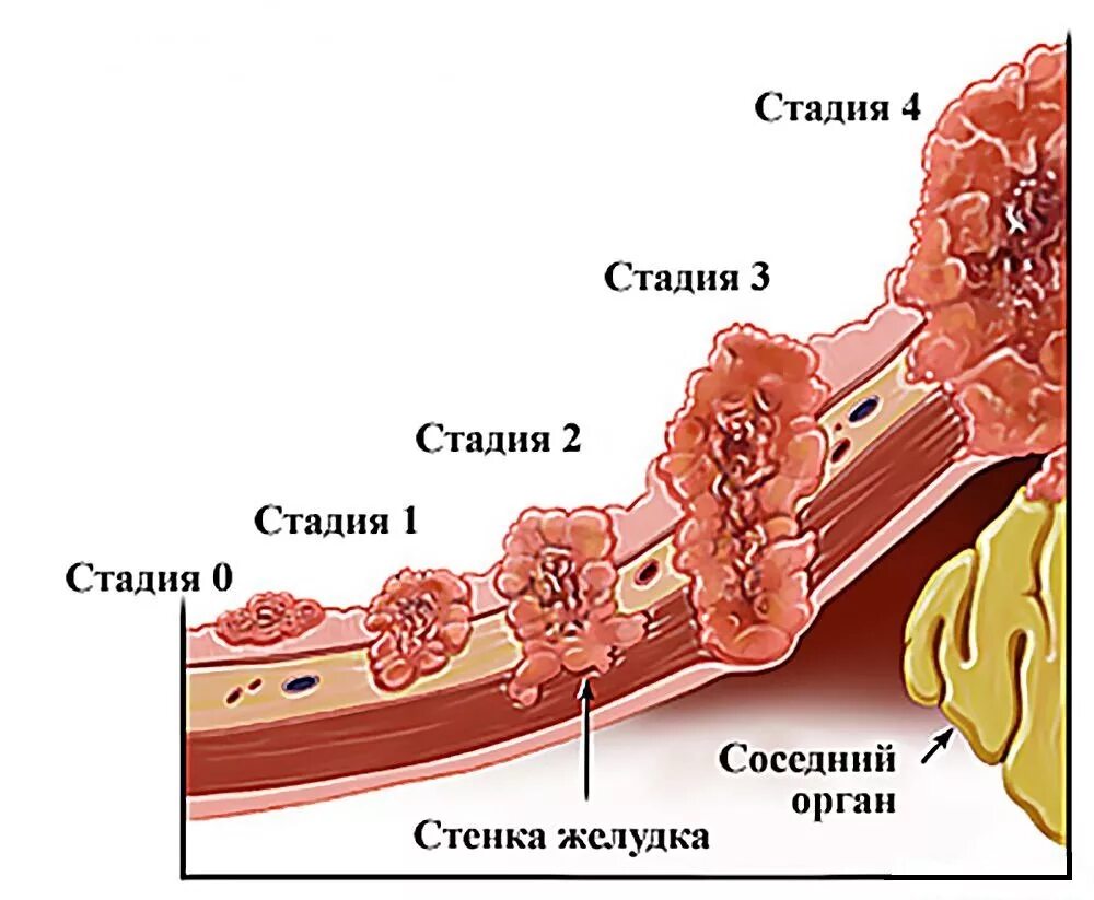 Онкология желудка 4 стадия