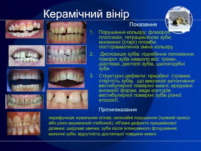 Классификация флюороза. Деструктивная форма флюороза.