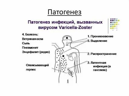 Патогенез ветряной оспы