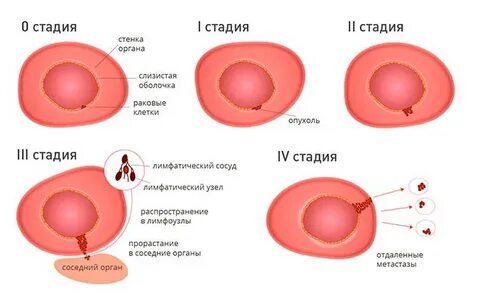Злокачественный опухоль 3 стадия