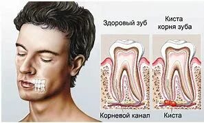 После удаления зуба держится температура