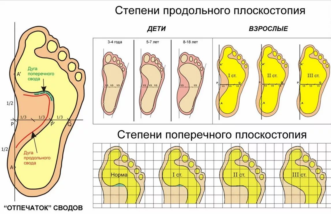 Плоскостопие второй степени берут ли в армию. Продольно-поперечное плоскостопие и вальгус 3 степени. Плоскостопие 1 степени 2 степени. Продольно-поперечное плоскостопие градусы. Степени продольного и поперечного плоскостопия.