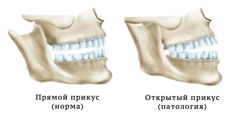 Открытый привкус. Открытый привкус. Ортогнатический прикус аномалия. Дистальный скелетный прикус. Красивые ровные зубы.