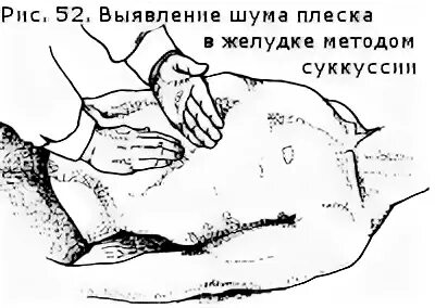 Острый эрозивный гастрит макропрепарат. Пальпация поджелудочной железы. Гипертрофический гастрит. Плеск в желудке. Плеск в желудке.