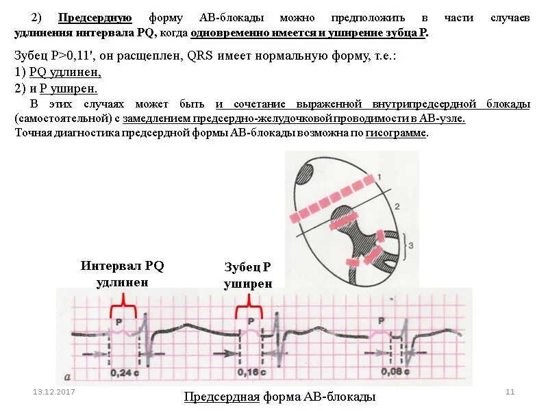 Предсердная блокада. Блокада зубца r ЭКГ. Расширение зубца r на ЭКГ. Расширение зубца р на ЭКГ. Удлинение зубца QRS.