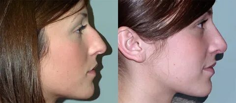 Female Nose Reshaping Riyadh