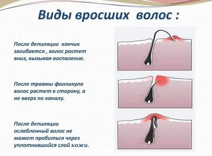 Что делать если появились вросшие волосы