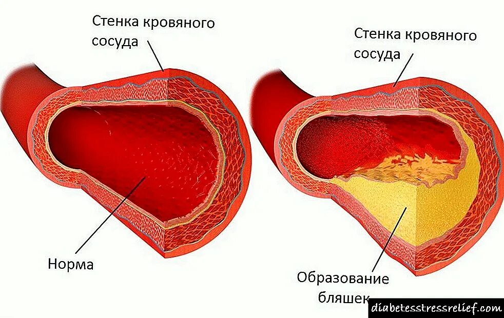 Образование артериальных бляшек. Как проверить сосуды на тромбы и холестериновые