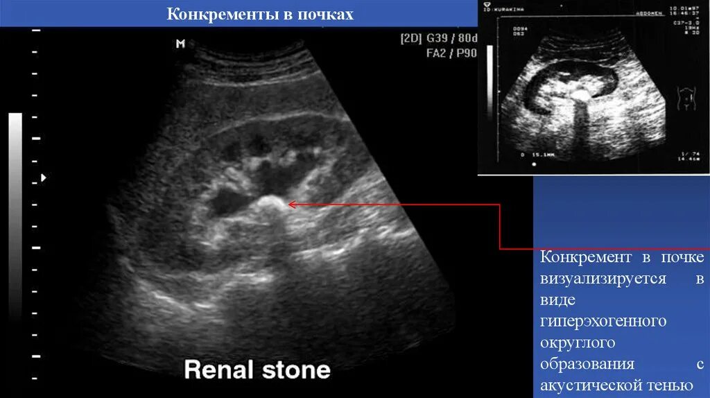 Акустические тени в почках. Конкремент лоханки УЗИ. Мелкий конкремент правой почки что это. Конкремент левой почки. Мелкие конкременты в почках на УЗИ.