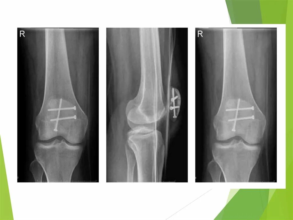 Повреждение мыщелка. Перелом надколенника рентген. Вывих надколенника рентген. Краевой перелом надколенника. Перелом надколенника открытый перелом.