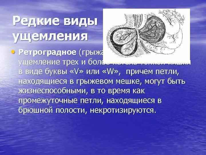 Ответы ущемленная грыжа. Ретроградное ущемление Майдля.