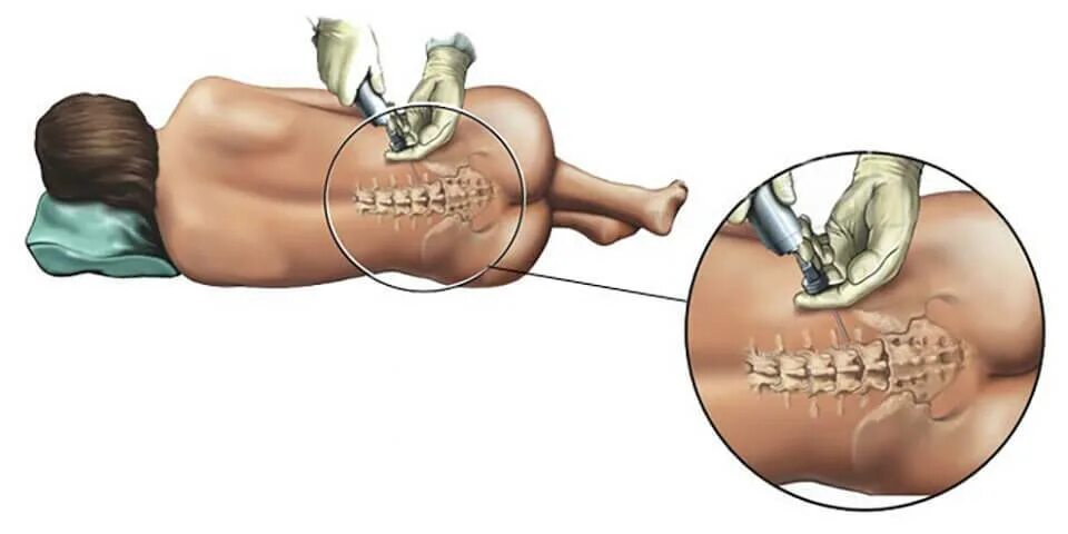 Боли в спине после эпидуральной. Спинномозговая (спинальная) анестезия. Операции с спинномозговой анестезией. Спинномозговая и эпидуральная анестезия. Спинномозговая анестезия хирургия.