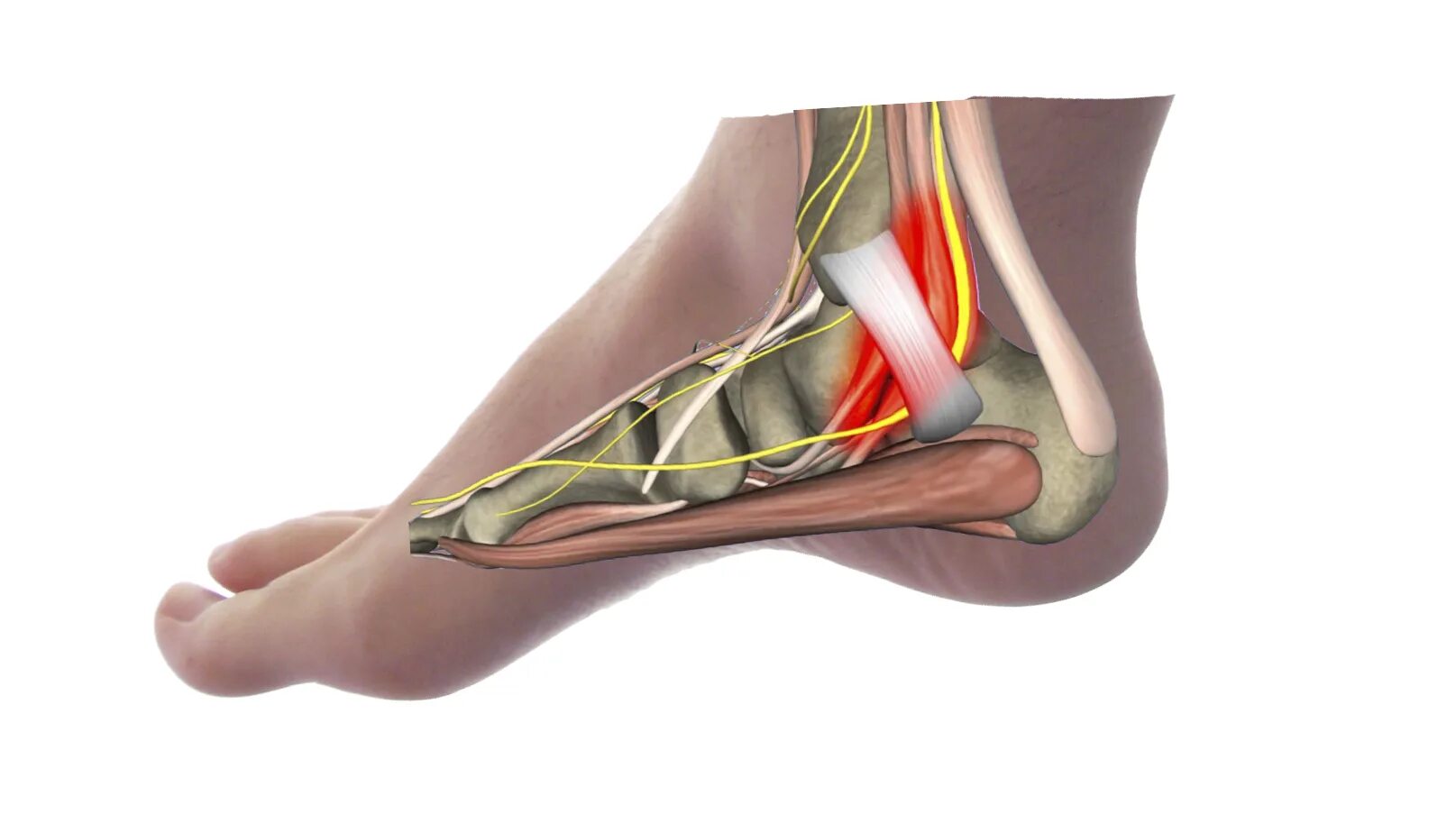 Тарзальный канал большеберцового нерва. Тарзальный туннельный синдром. Туннельный синдром голеностопа. Туннельный синдром ступни. Болит пятка вступать больно