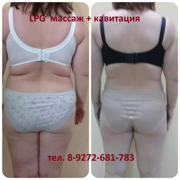 Кавитация отзывы до и после 