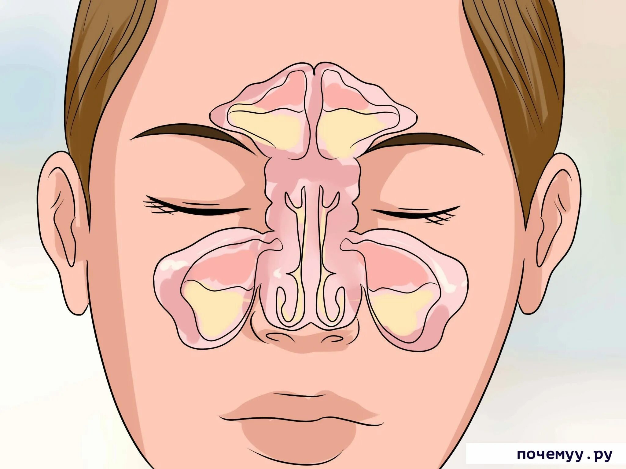 Постоянно заложен нос причины. Гайморовы пазухи гайморит. Пазухи носа анатомия гайморит. Синусит верхнечелюстной пазухи. Острый Гнойный пансинусит.