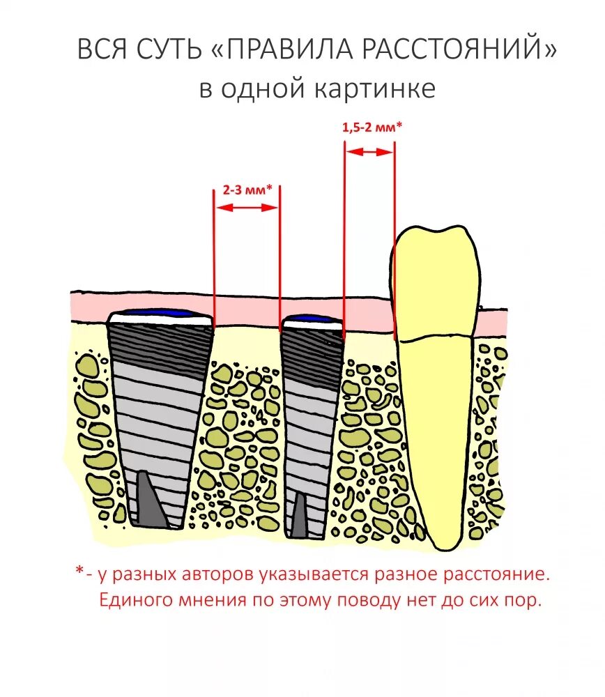 Какое расстояние между зубами. Минимальное расстояние между имплантом и зубом. Расстояние между имплантами зубов. Имплант между зуб расстояние. Минимальное расстояние между зубами для установки импланта.