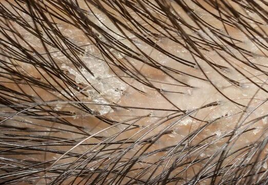 Перхоть под микроскопом у человека как выглядит Dandruff In The Hair And Scalp Macro Shot Stock Photo Download Image Now iSt