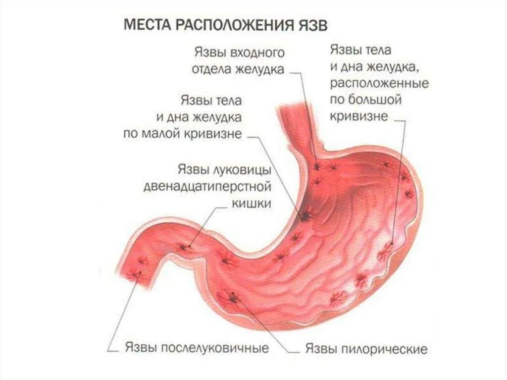 Язва желудка и двенадцатиперстной кишки. Язвенная болезнь желудка локализация. Язва желудка и 12 перстной кишки. Язвенная болезнь желудка и 12-ти перстной кишки.