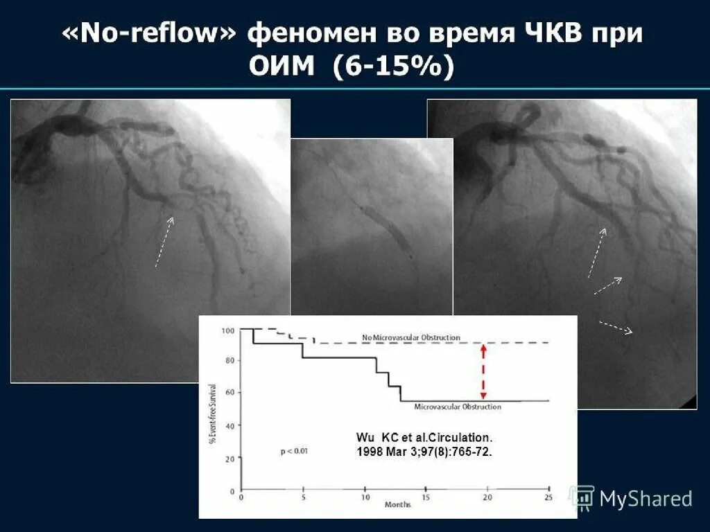 Стентирование при инфаркте миокарда