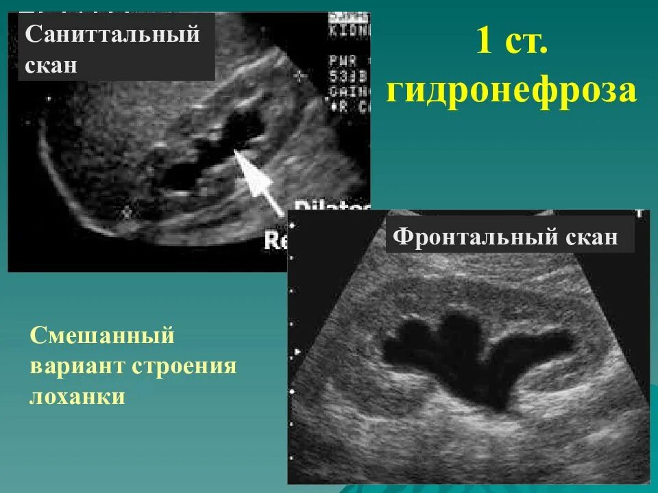 Узи лоханки почки. Гидронефроз почки УЗИ. Гидронефроз 3 степени УЗИ. УЗИ почек гидронефроз 1ст.