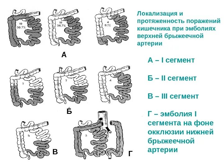 Тромбоз брыжеечной артерии. Мезентериальный сосудов кишечника. сегменты ствола верхней брыжеечной артерии. классификация мезентериального тромбоза. сегменты артерий кишечника.