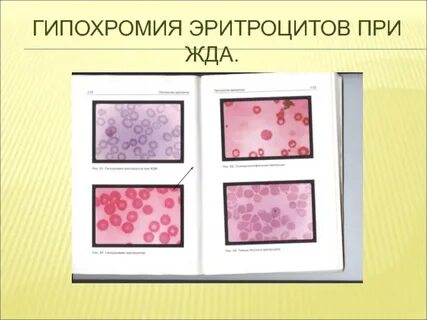 Гипохромия что это