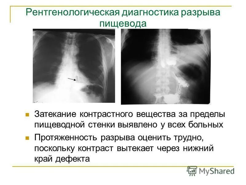 спонтанный разрыв пищевода