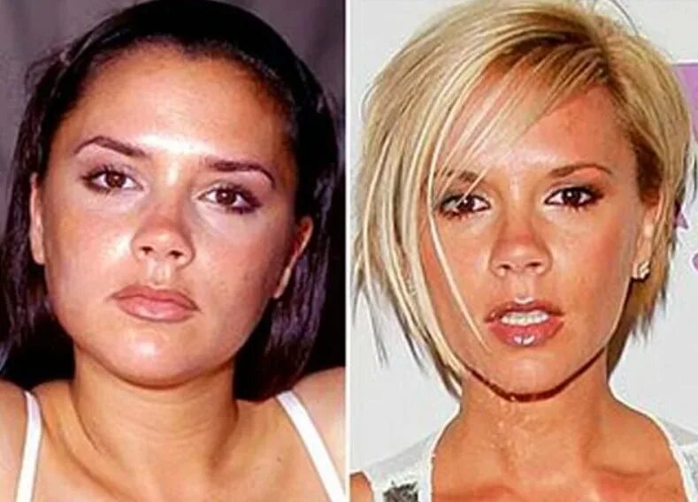 комки биша звезды полина гагарина. алсу комки биша. виктория бекхэм до пластики. меган фокс до и после. пластика лица комки биша.