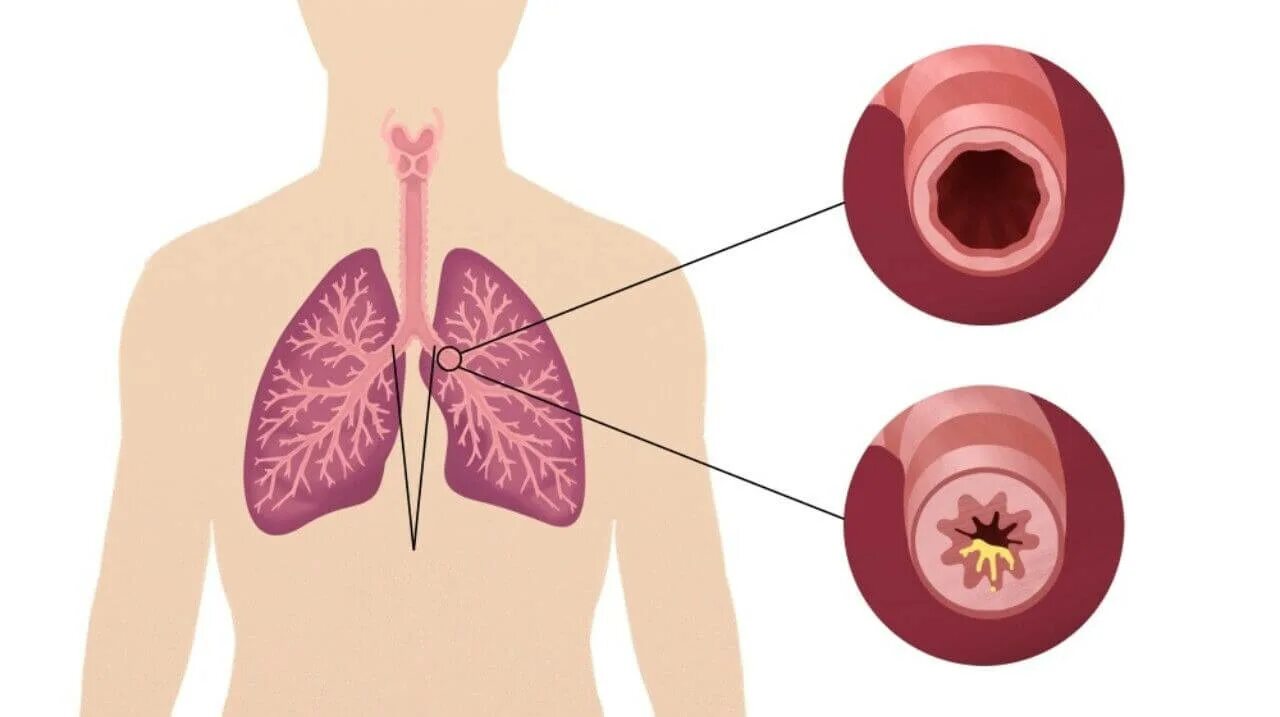 Сухой кашель у ребенка без температуры. Кашель с мокротой 10 лет. Кашель с мокротой причины. Мокрый кашель. Кашель с отхаркиванием слизи.