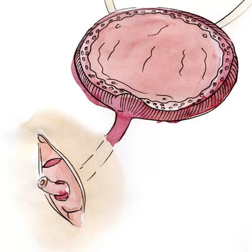 Циститы после близости. Посткоитальный цистит. Поистконотальеый цестиь. Посткоитальный цистит у женщин. Кровотечение из уретры.