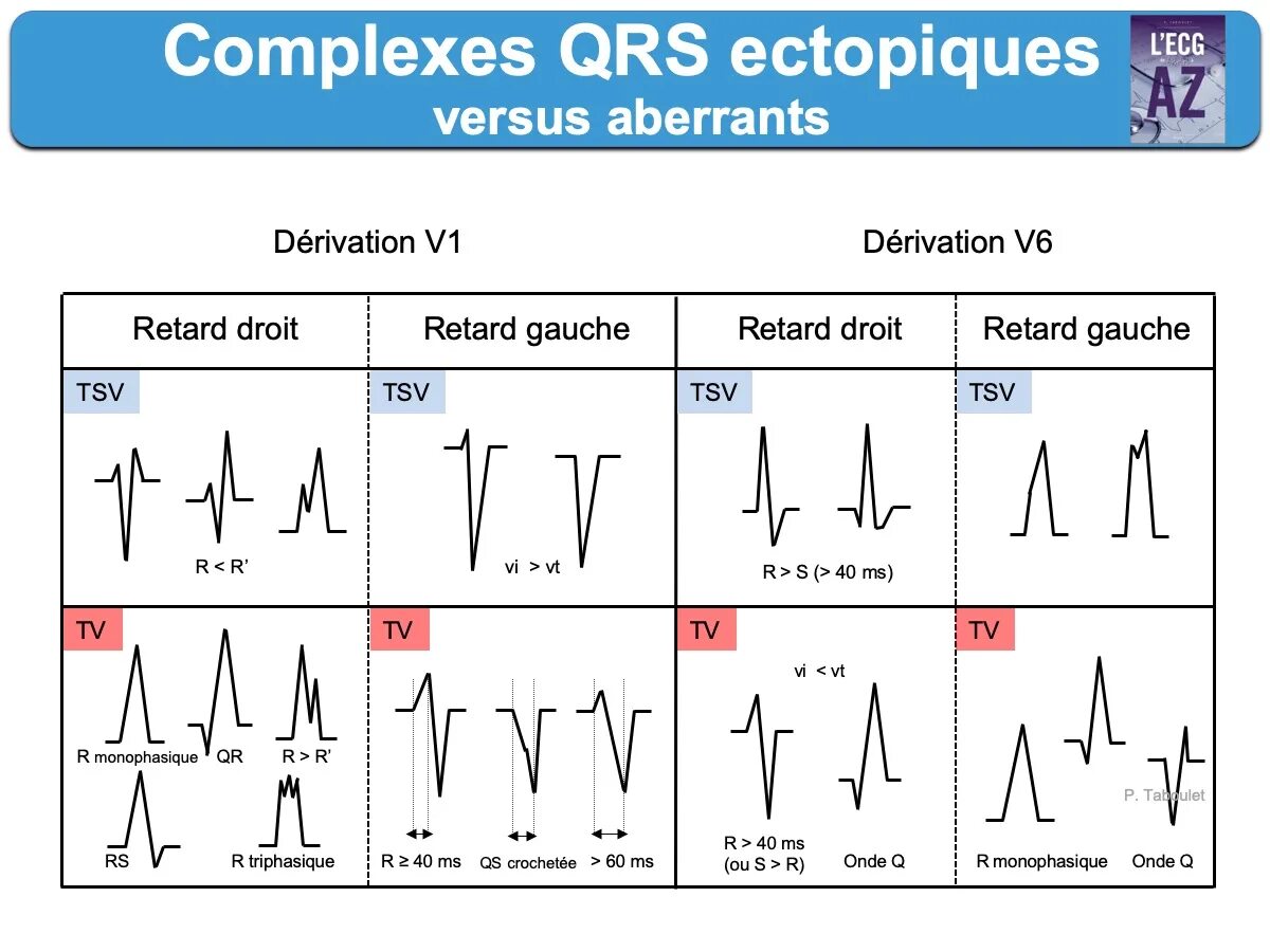 Изменение комплекса qrs. Отрицательный комплекс qrs на экг. комплекс qrs на экг. расширение комплекса qrs на экг. экг комплекс qrs в v2.