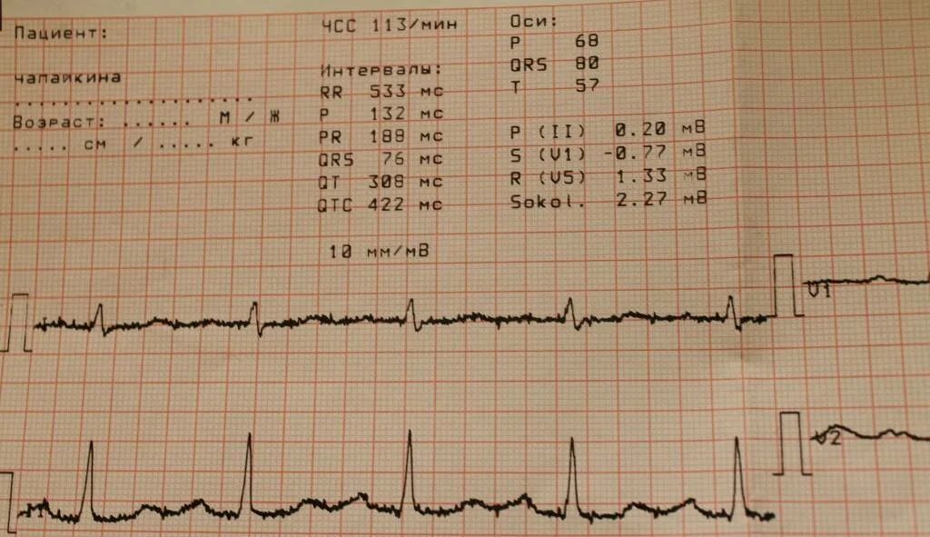 Мв на экг. Ось QRS норма ЭКГ. ЭКГ P PQ QRS RR 1.048. ЭКГ сердца PQ 0,10. Alpha QRS на ЭКГ норма.