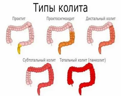 Сигмоидит симптомы лечение болит живот слева
