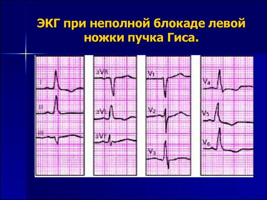 Блокада левой ножки пучка гиса на экг. Неполная блокада ЛНПГ на ЭКГ. Полная и неполная блокада левой ножки пучка Гиса. Неполная блокада левой ножки пучка Гиса.