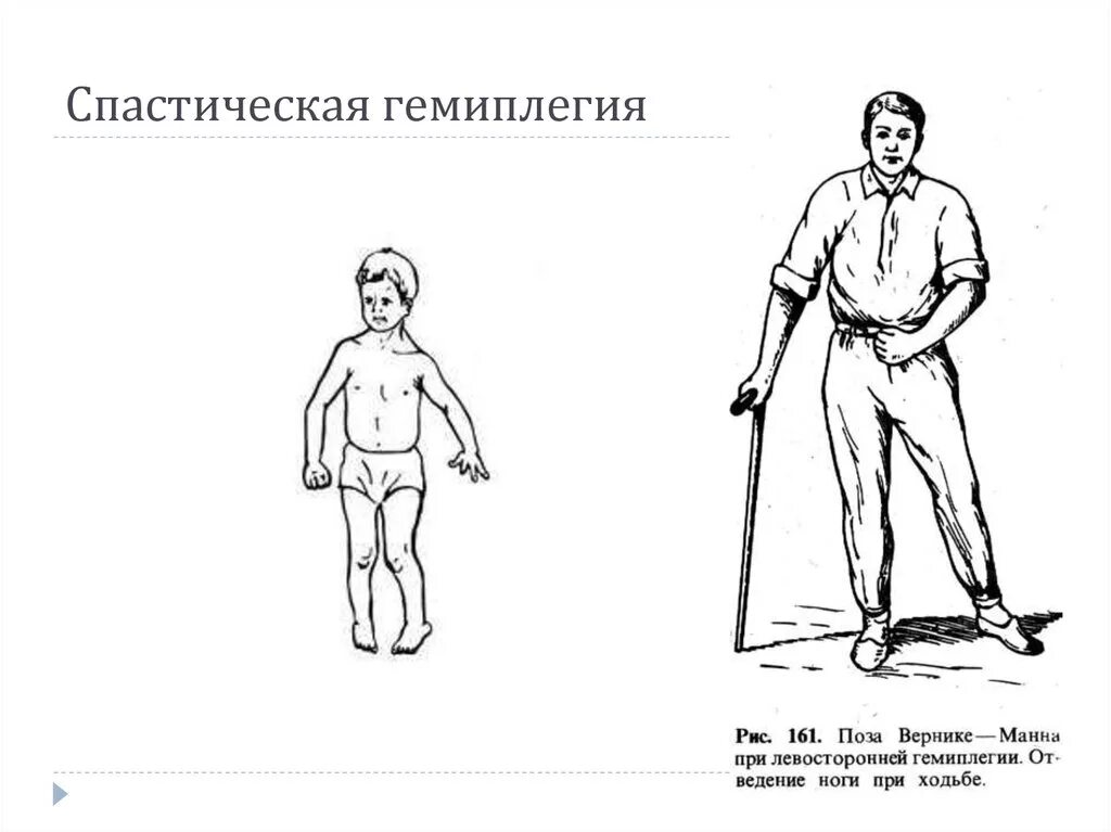 ДЦП спастический гемипарез. Правосторонняя гемиплегия очаг поражения. Двойная гемиплегия форма ДЦП. ДЦП, гемиплегическая форма (правосторонний гемипарез). Гемипарез руки