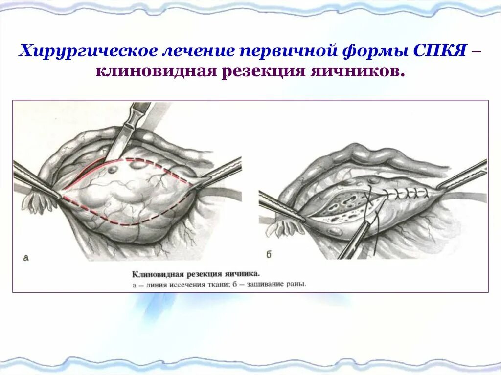 Удалить яичники и оставить матку