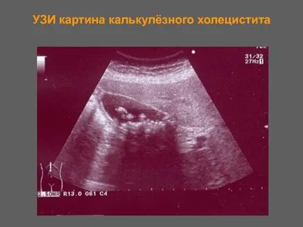 Калькулезный холецистит