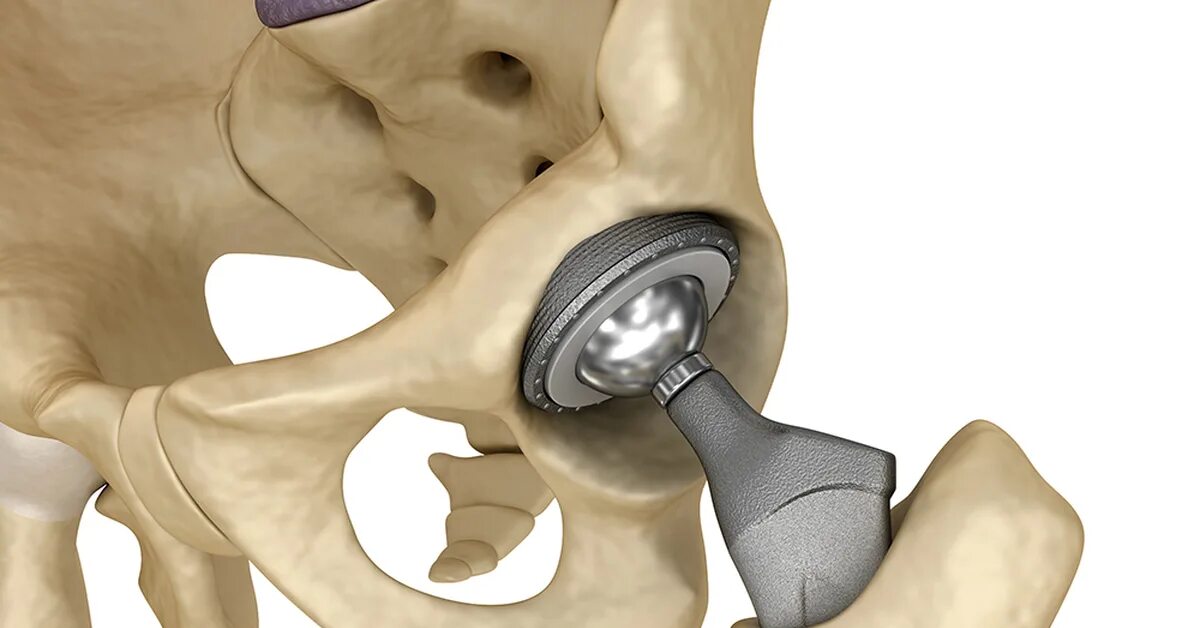 Эндопротез тазобедренного сустава. Эндопротезирование коленного и тазобедренного сустава. Перипротезная инфекция тазобедренного сустава. Протез тазобедренного сустава. Эндопротезирование отзывы после операции