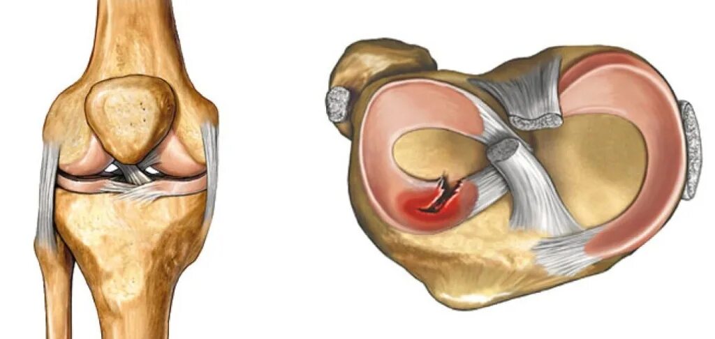 Передний рог коленного сустава. Разрыв медиального мениска. Разрыв заднего рога медиального мениска. Разрыв мениска коленного сустава 3 степени. Задний Рог медиального мениска.