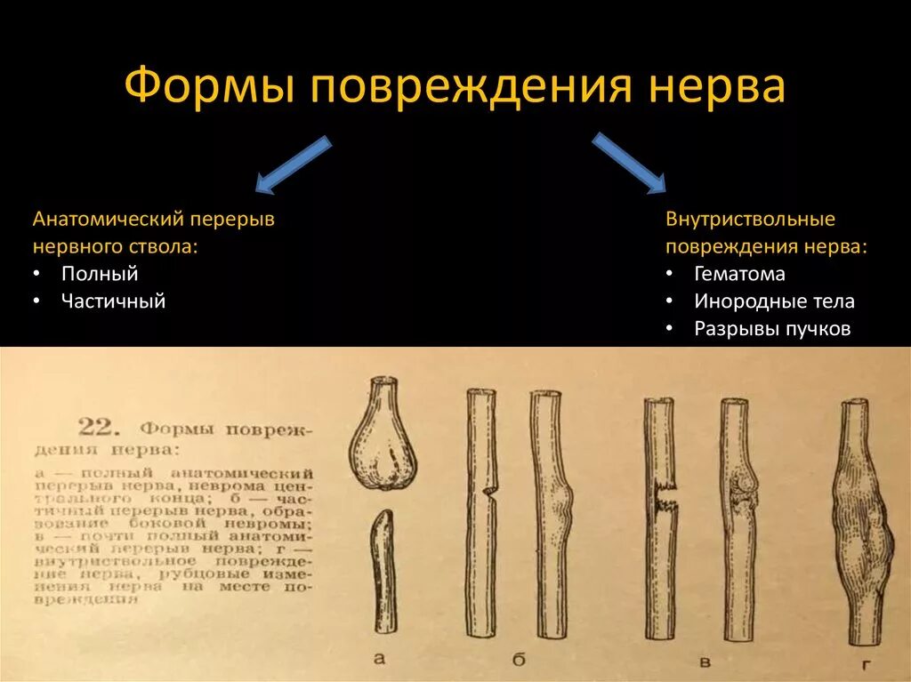 Классификация травматических повреждений периферических нервов.. Механизмы повреждения периферических нервов. Формы повреждения нерва.