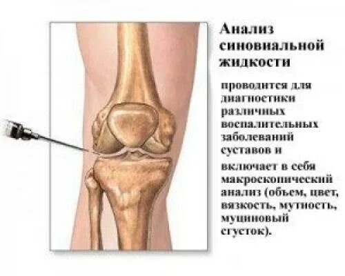 Жидкость в коленном суставе. Синовиальная жидкость в коленном суставе. жидкость в коленном суставе синовит.