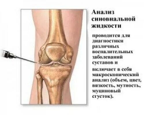 Собирается жидкость в суставах. Синовиальная жидкость в коленном суставе. Синовит колена коленного сустава. Пункция синовиальной жидкости коленного сустава. Синовит артроз коленного сустава.