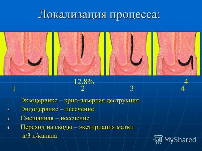 Эндоцервикс слизь